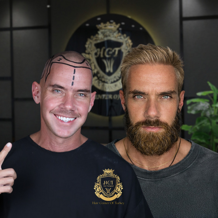 Top 5 Hair Transplant Clinics in Turkey in 2026